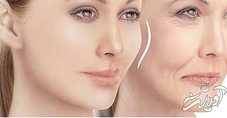 پروتز گونه, پروتز گونه چیست, انواع پروتز گونه